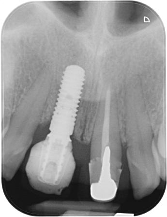 Radiografia post-operatoria