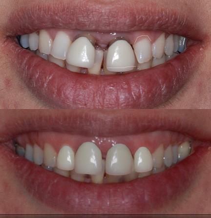 Digital smile-design