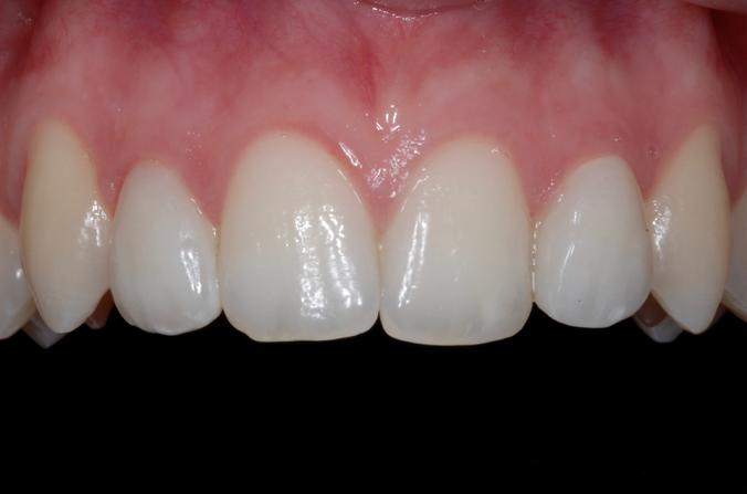 Faccette in ceramica sugli incisivi laterali denti 22 - 12 e composito sul 21